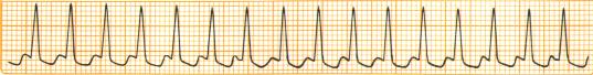AtrialTachycardia(AT).jpg